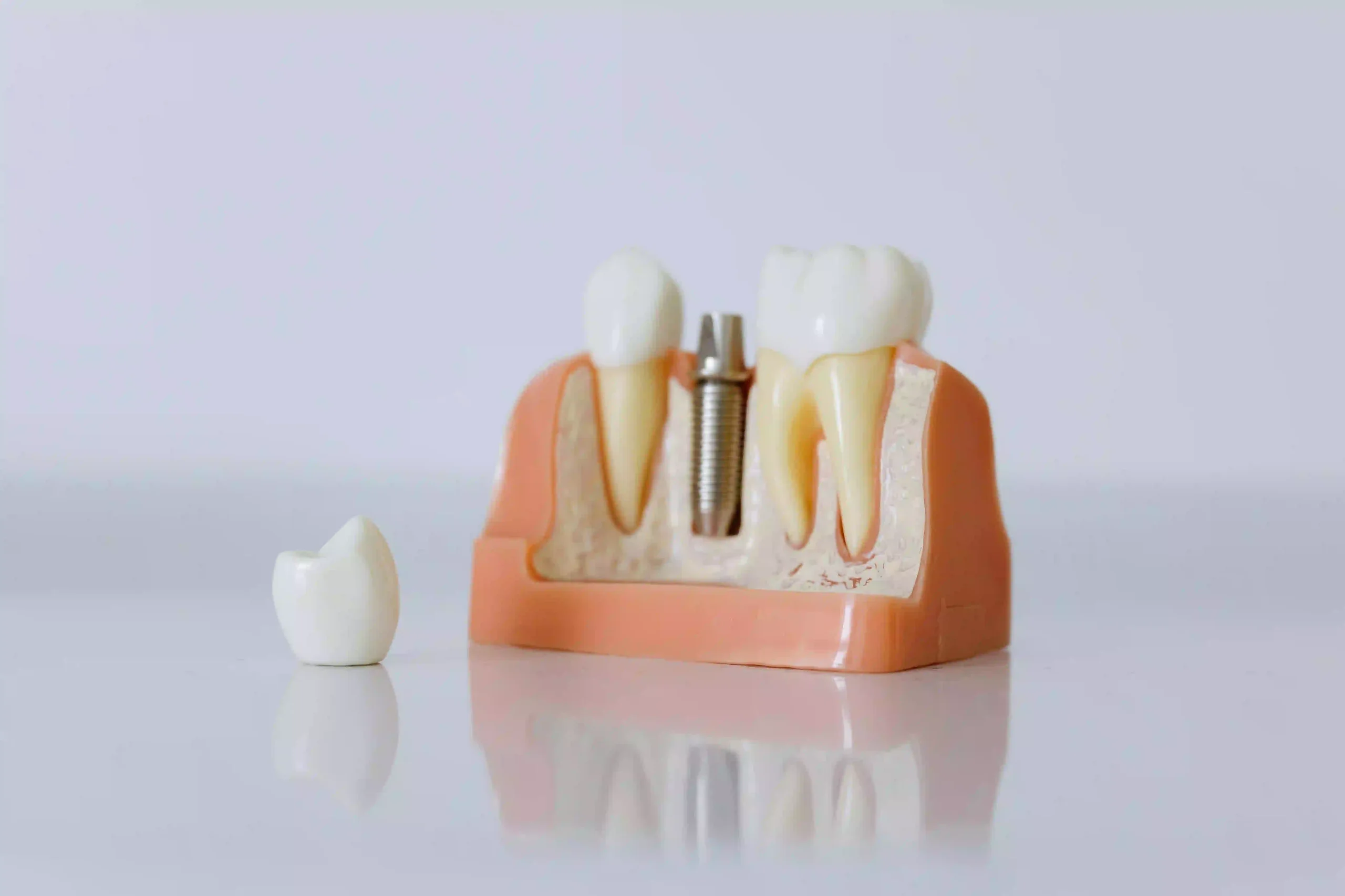 🦷 How Safe and Durable Are Medentika Dental Implants?