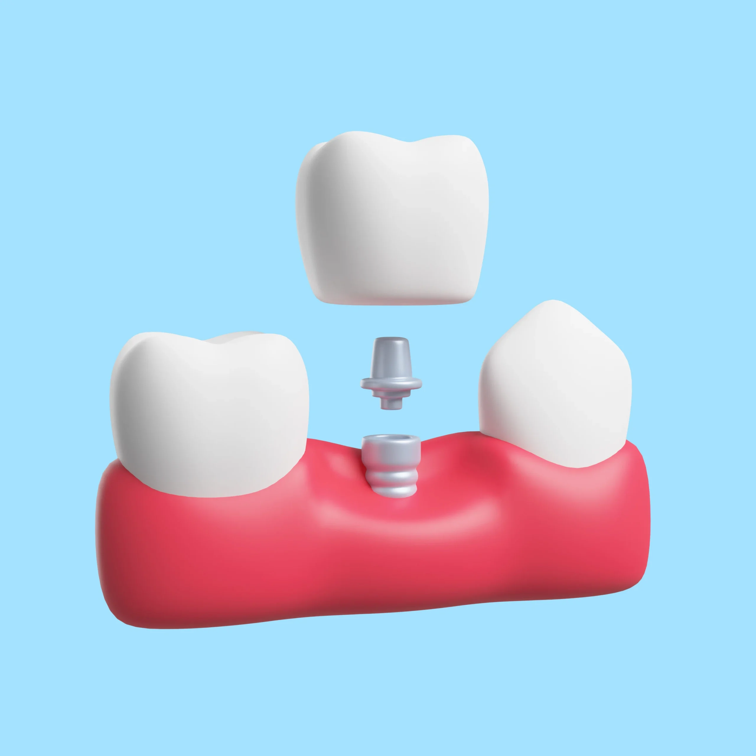 are Straumann are hiossen dental implants dental products strong safe