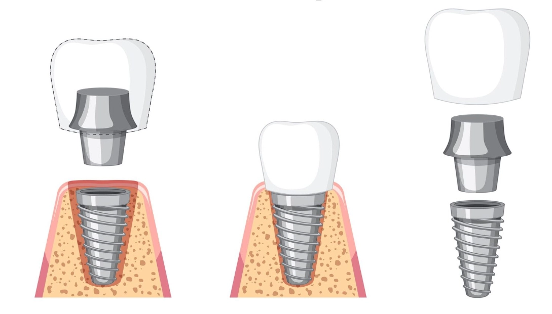 are biohorizons dental implants dental products strong safe