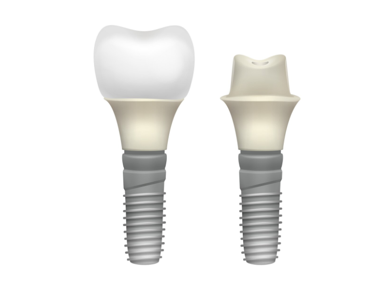 are dentsply sirona dental implants dental products strong safe (2)