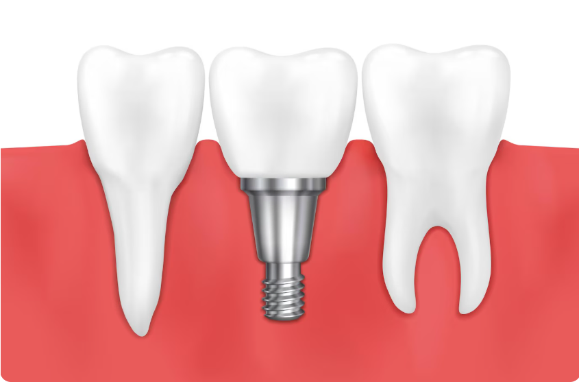 are nobel biocare dental implants dental products strong safe