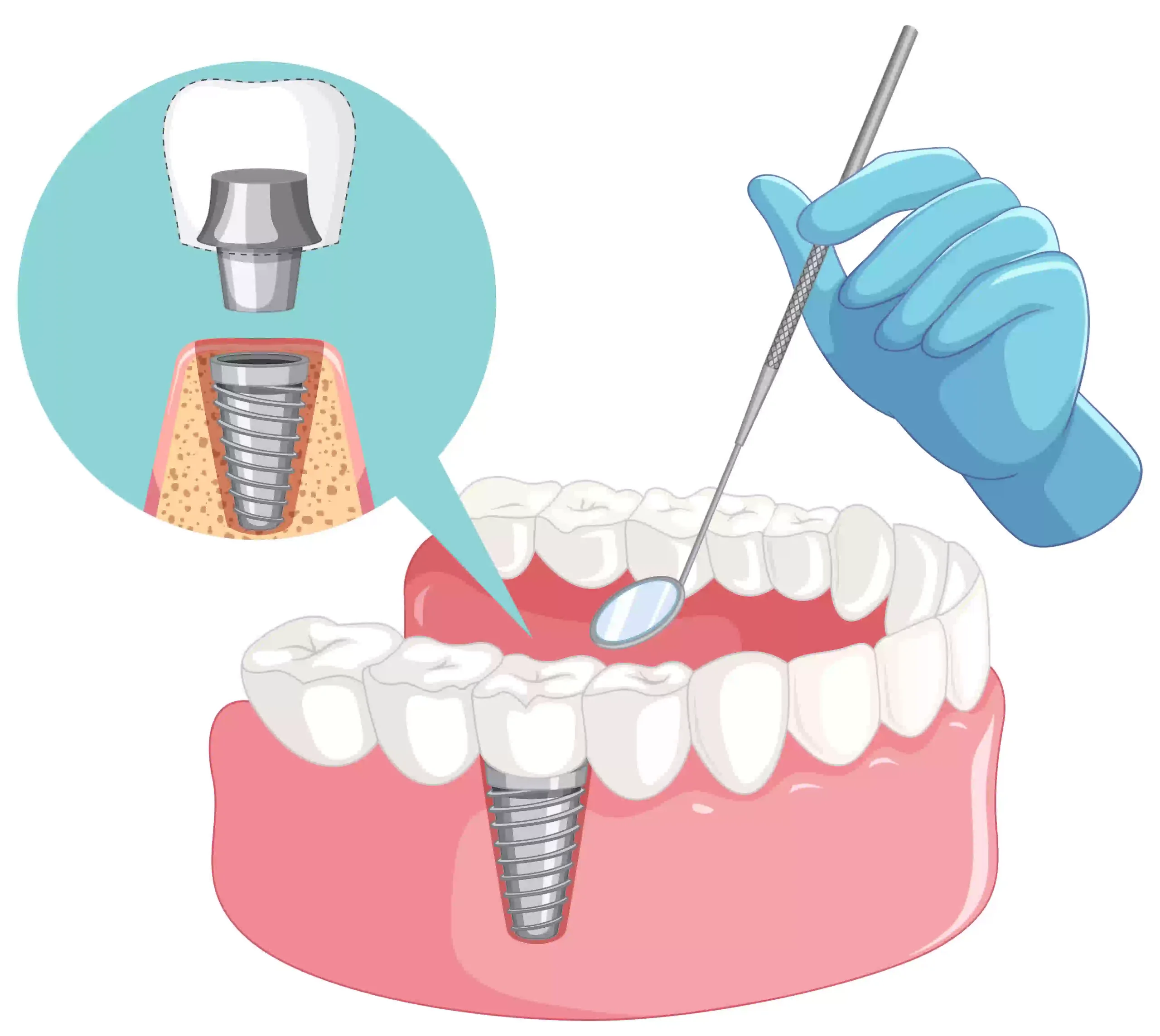 are zimmer biomet dental implants dental products strong safe