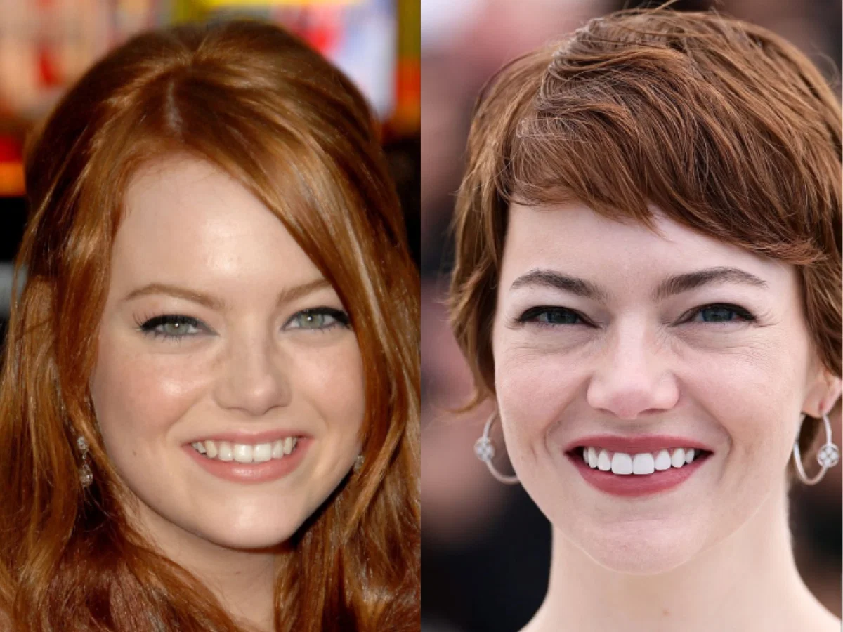 Emma Stone's teeth before after