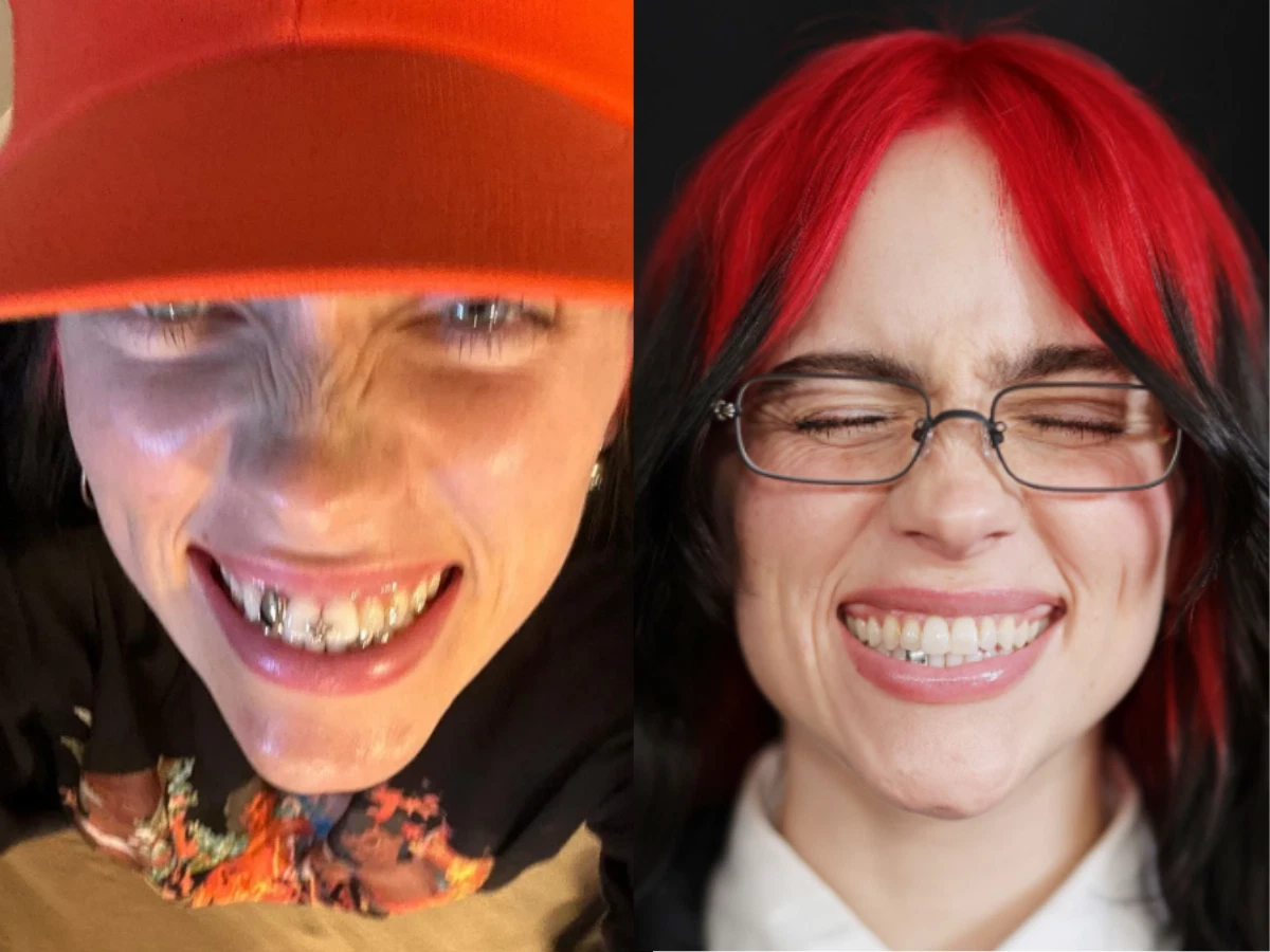 billie eilish teeth before after