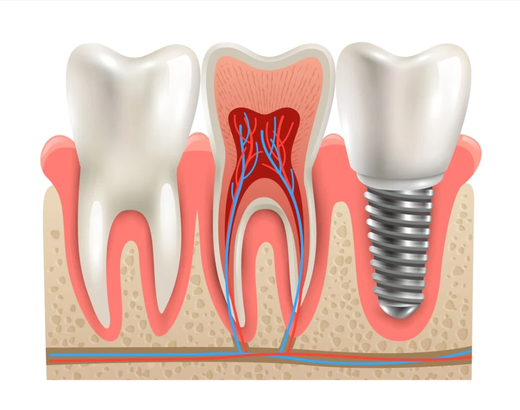 coût des implants dentaires