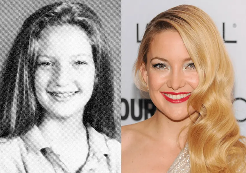 kate hudson teeth transformation