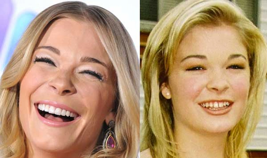 Leann Rimes Teeth (Old/New): Before and Afters - Lema Dental Clinic - LEMA