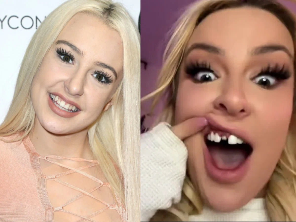 tana mongeau teeth before after