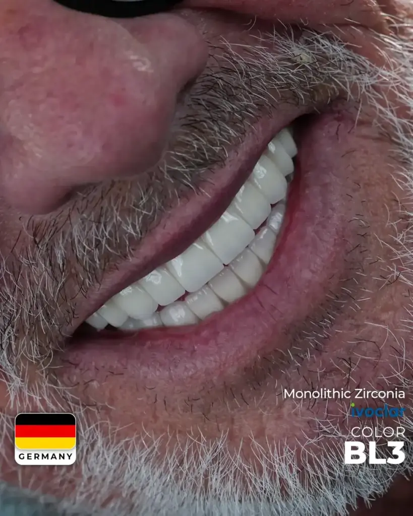 🦷 Dental Implants: Before & After Photos in Istanbul, Turkey! | LEMA