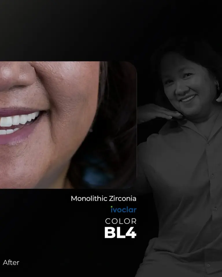 Lema Dental Clinic offers an impressive smile in 5 days 🌟Treatment Hollywood Smile 😁Material (4)