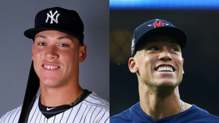 aaron judge teeth before after