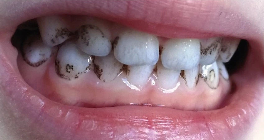 black stains teeth