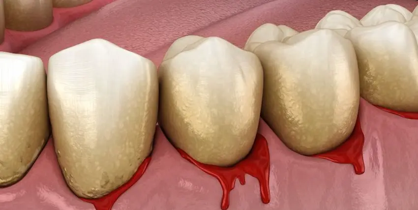 bleeding gums