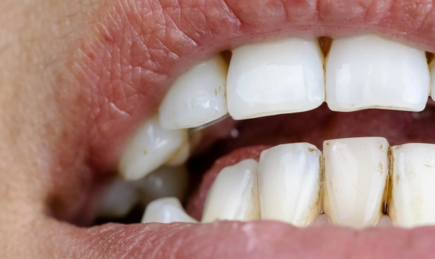 can the black stains on teeth be removed
