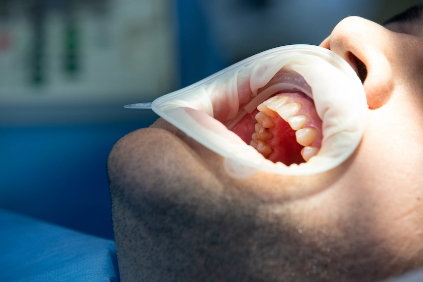 considerazioni post otturazione dentale