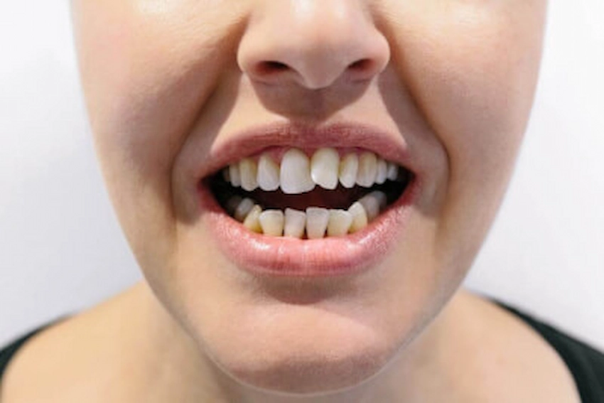 denti storti