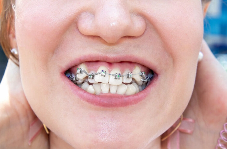 crowded teeth problems and meral braces