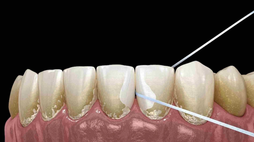 إزالة المعادن من السن