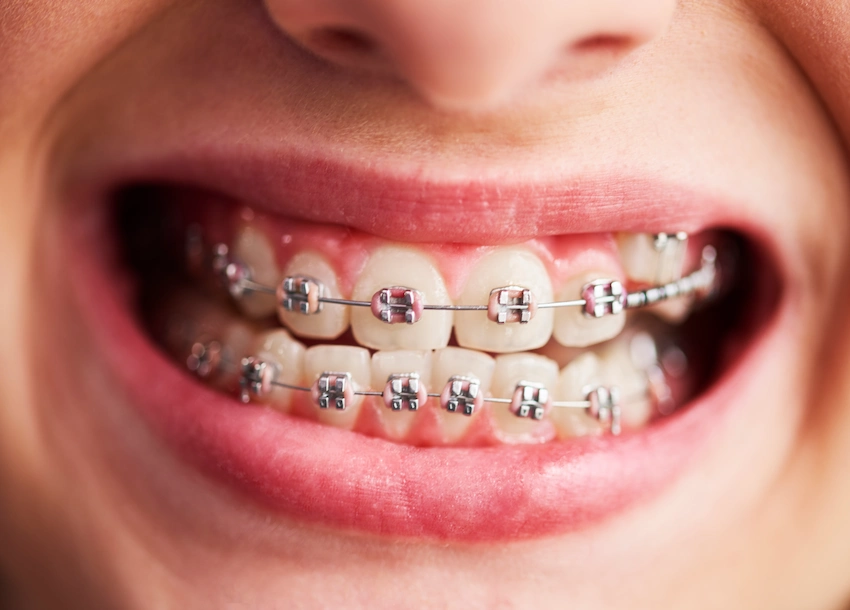 apparecchi dentali