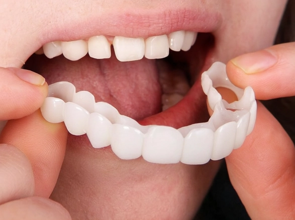 dental clips for missing teeth