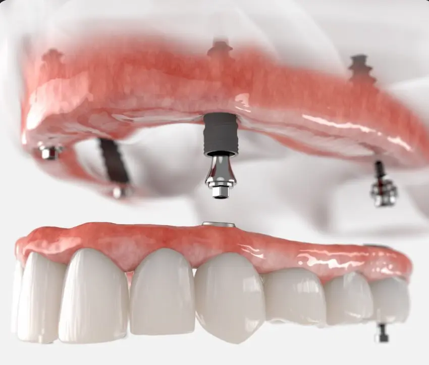 dental implants versus dentures