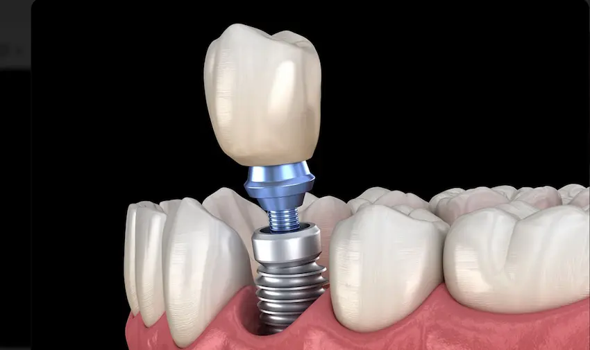 dental implants