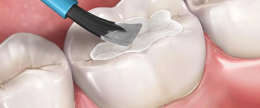 dental sealants