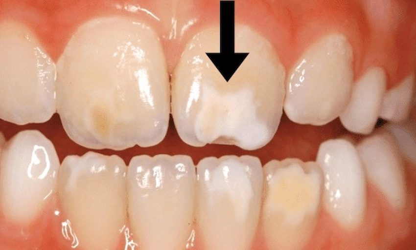 discoloration teeth kids