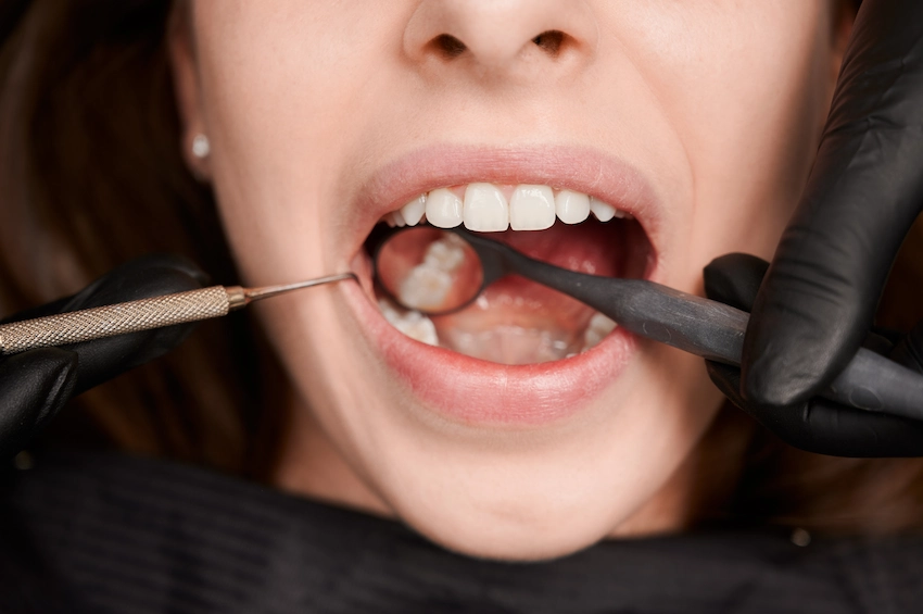 do you need antibiotics after a tooth extraction