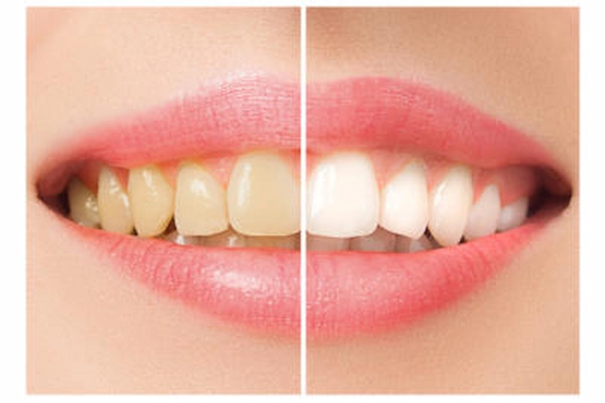 ¿Causa fumar pérdida de dientes?