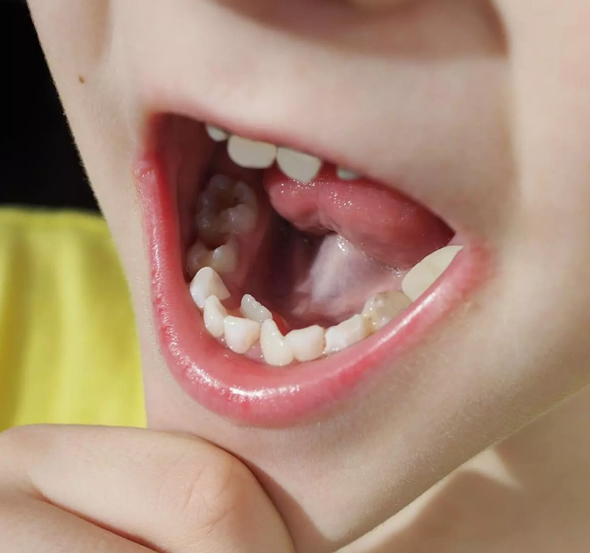 extra teeth growing in gums