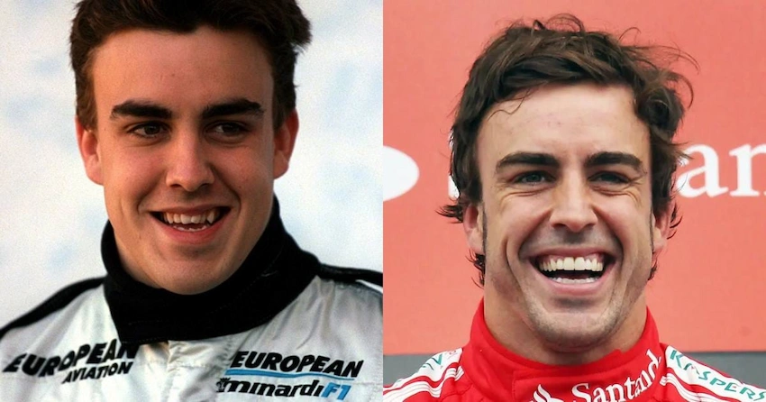 fernando alonso teeth before after