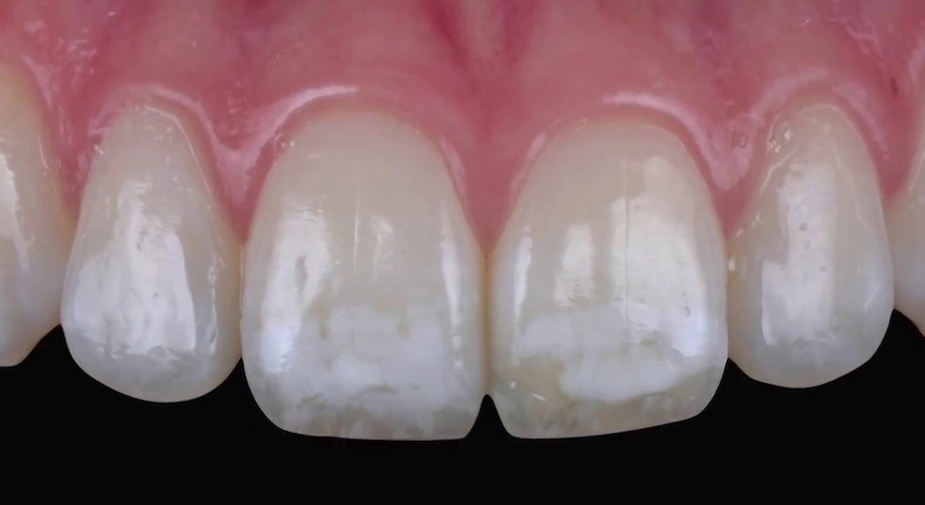 fluoride stains