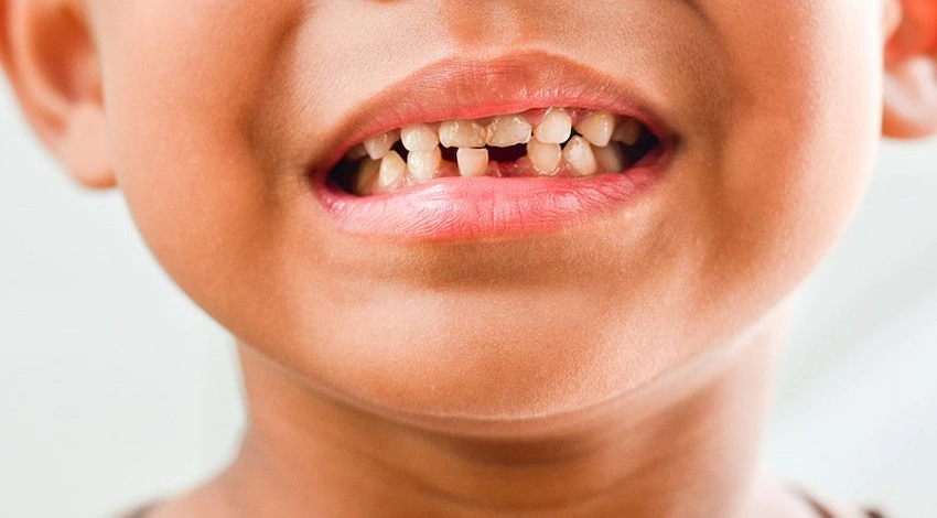 front tooth decay causes treatments and solutions