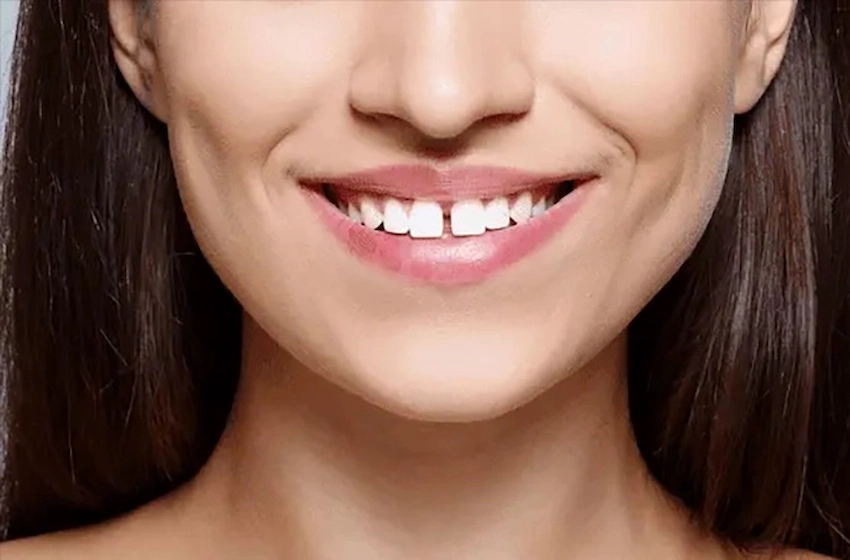 gap between front teeth problems