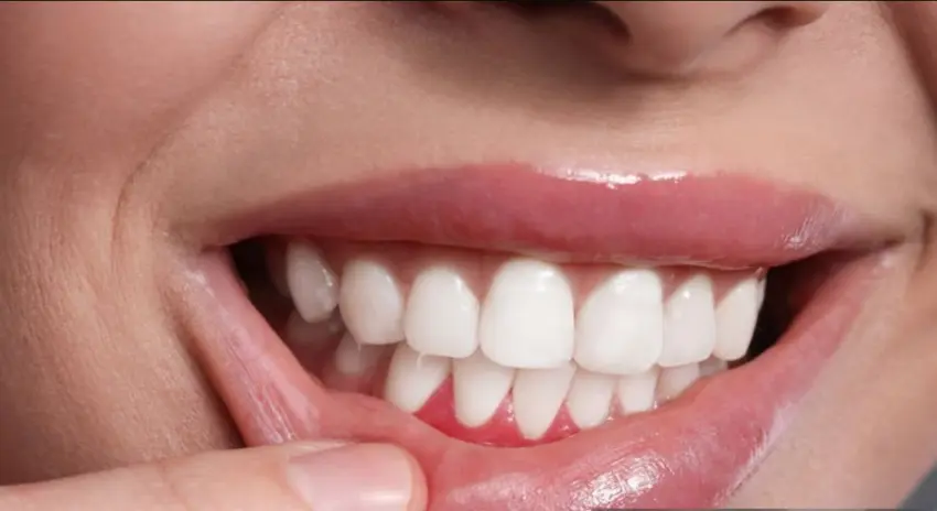 gum dental