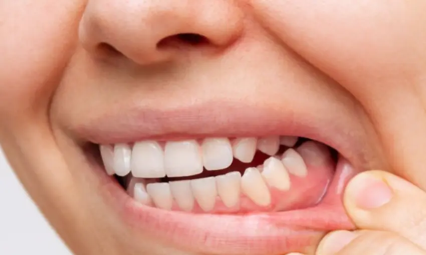 gum teeth