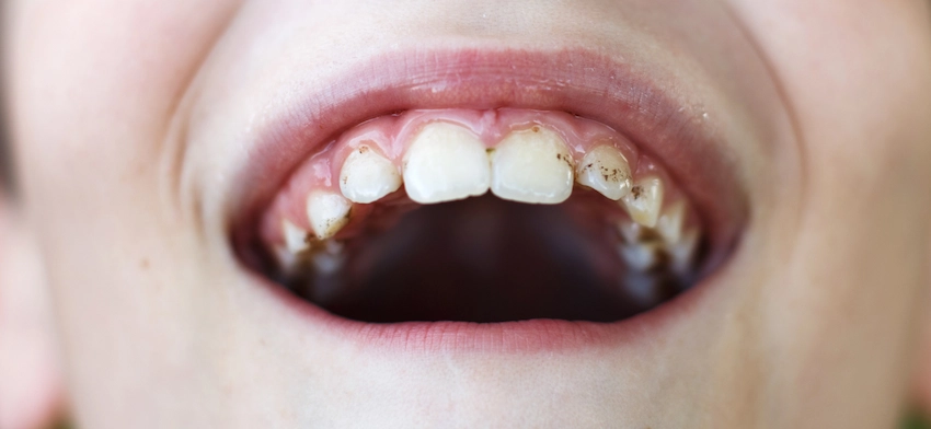 how can i prevent black stains on teeth