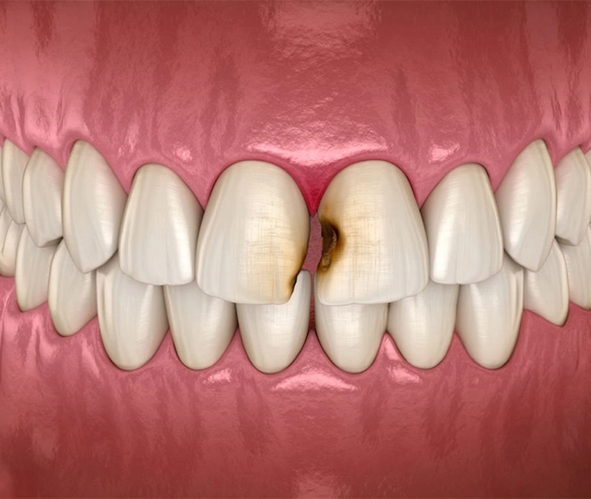 comment traiter la décomposition des dents de devant