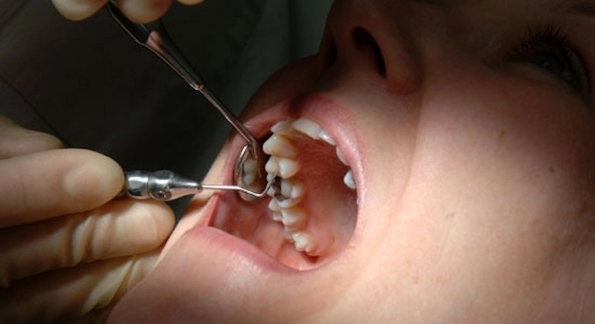 cómo tratan los dentistas la caries en la raíz del diente