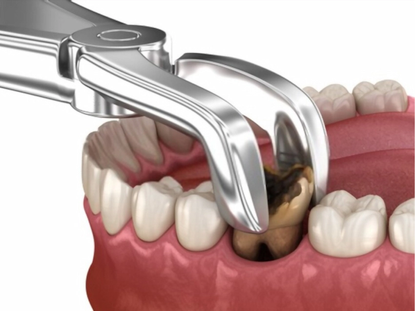 cómo prevenir la caries en la raíz del diente