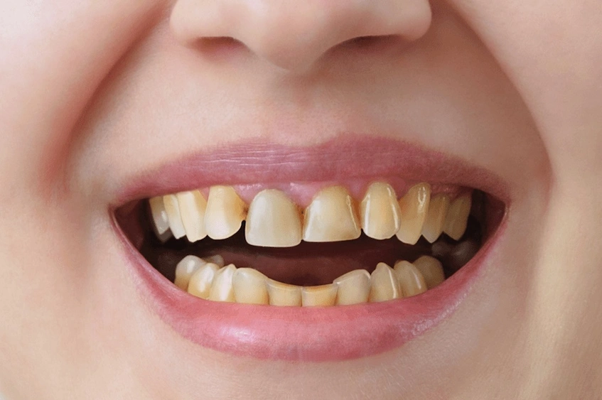 iron deficiency teeth