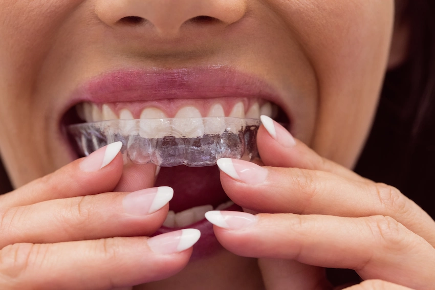 è possibile esfoliare in qualsiasi momento con gli allineatori trasparenti