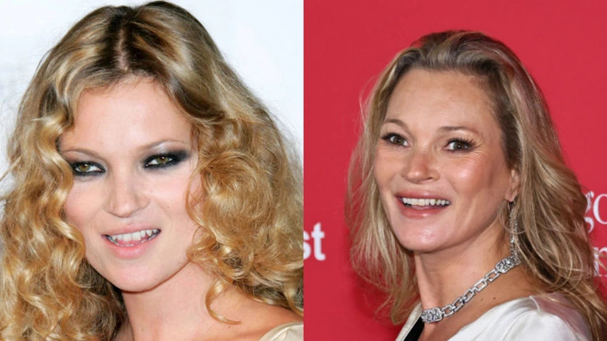 kate moss teeth before after