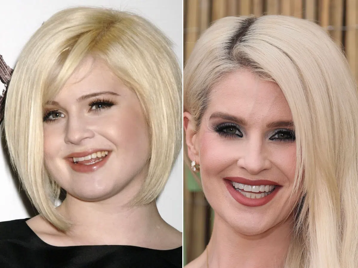 kelly osbourne teeth before after