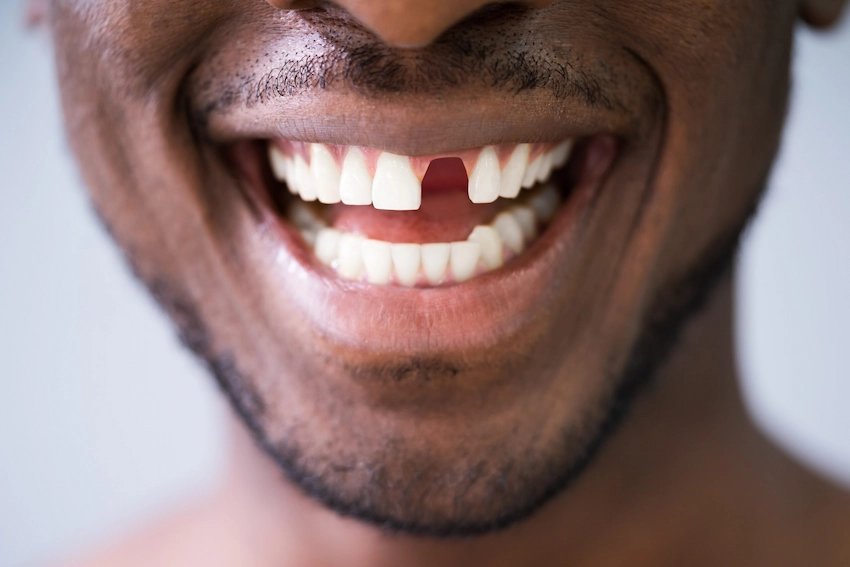 knock out teeth