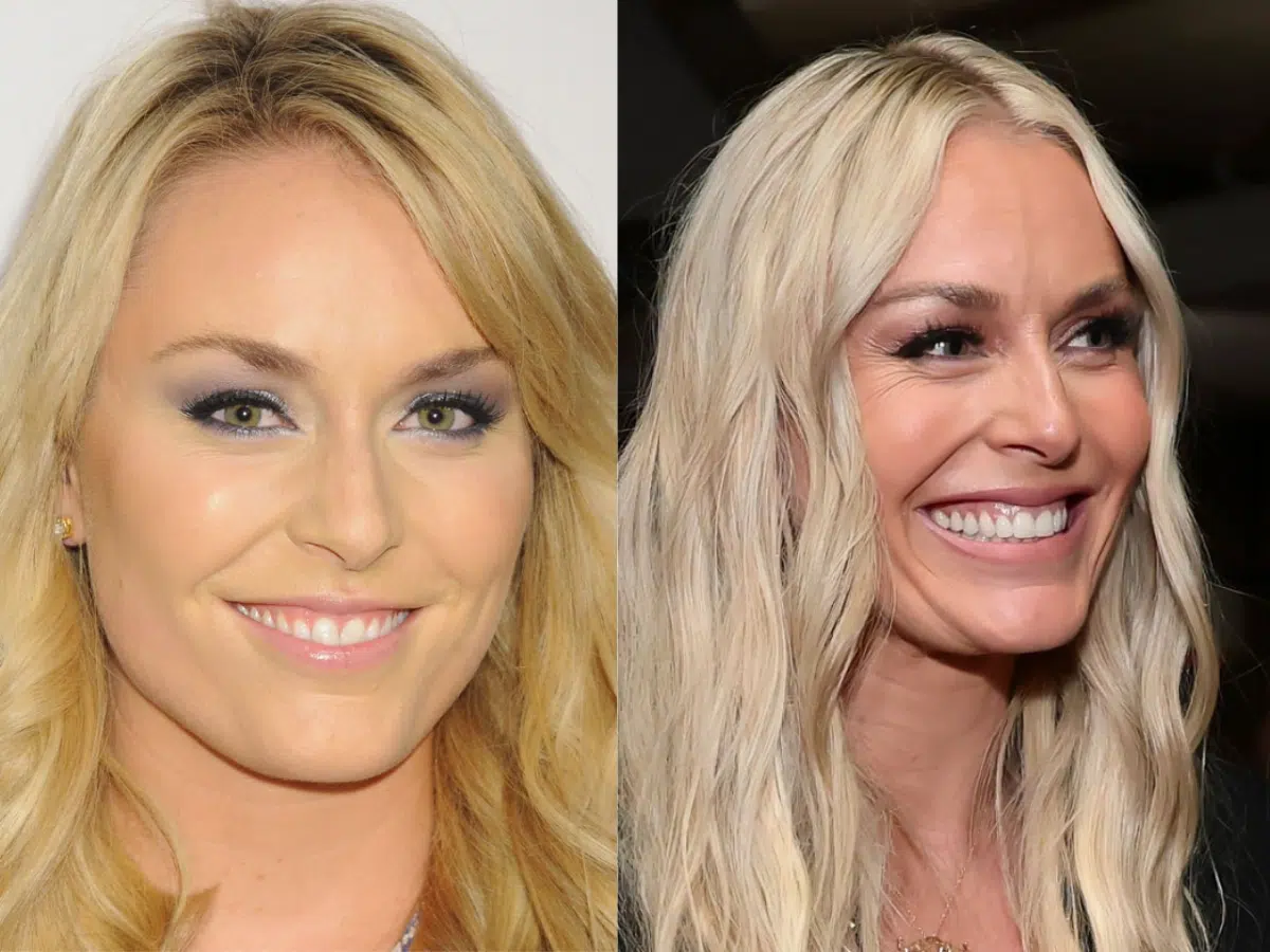 lindsey vonn teeth before after