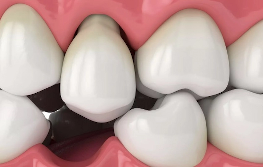 dents lâches