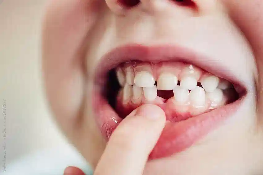 milk teeth 1