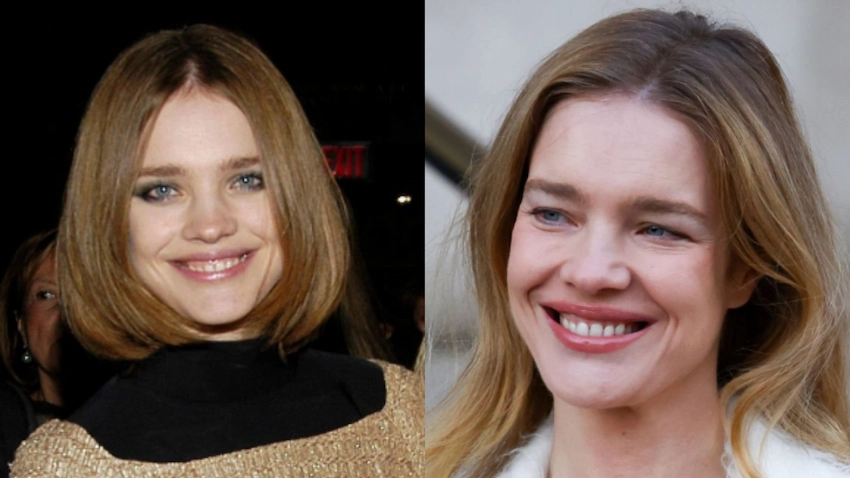natalia vodinanov teeth before after